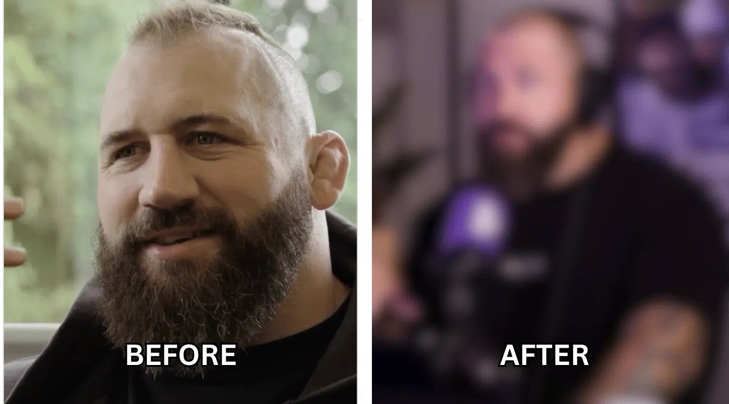 Joe Marler showing his hair transplant results